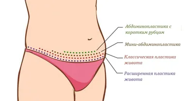 Абдоминопластика у мужчин. Фото, отзывы | Интернет-журнал Estetmedicina.ru