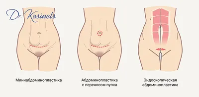 Абдоминопластика - фото до и после проведения операции по пластике живота