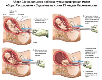 Аборты. Право на убийство