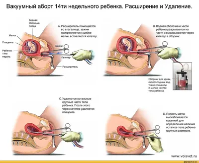 аборт / смешные картинки и другие приколы: комиксы, гиф анимация, видео,  лучший интеллектуальный юмор.