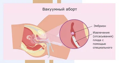 Наша дочь прожила 11 дней\": пара отказалась от аборта, зная о болезни  ребенка