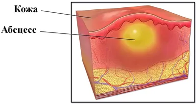 Абсцесс кожи – причины, симптомы, диагностика и лечение болезни кожи у  взрослых | «Будь Здоров»