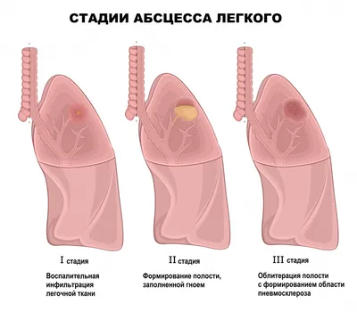 Абсцесс | симптомы и причины заболевания, диагностика и лечение кожи