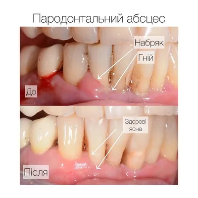 Абсцесс зуба. Диагностика и лечение в Балашихе