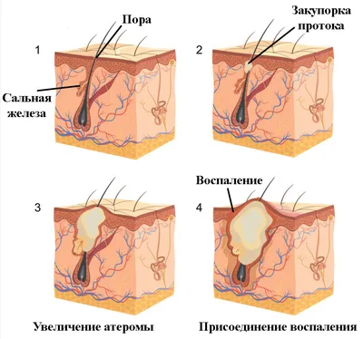 Абсцесс: паратонзиллярный, или горла, заглоточный, легкого, печени