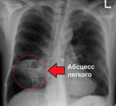 2.7. Атеромы, абсцессы и флегмоны кожи грудной стенки