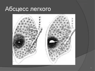 Абсцесс печени - Лучевая диагностика в педиатрии