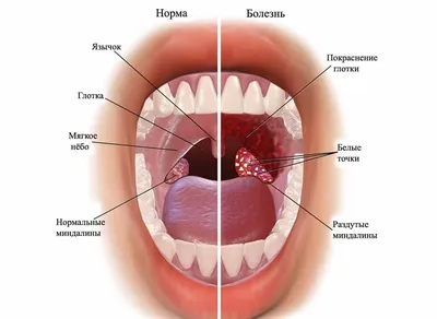 Абсцесс горла фото