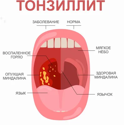 Заглоточный абсцесс | zdrav.kz