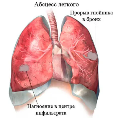 Болезни горла: последствия и осложнения | Faringospray | Дзен