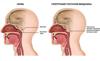 Хронический аденоидит (аденоиды, аденоидные вегетации, гипертрофия  аденоидов).