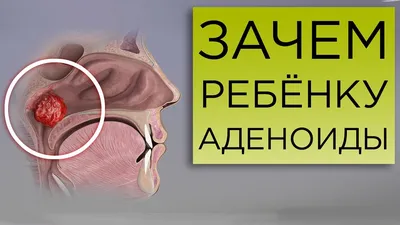 Гланды, аденоиды, миндалины у ребенка и взрослого: в чем разница, где  находятся, симптомы и лечение