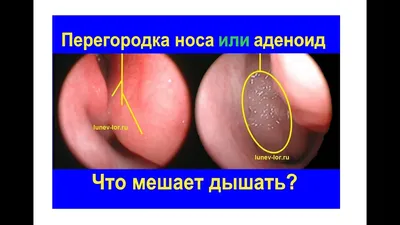 Аденоиды у детей: причины, симптомы и методы лечения | Klinik.by - Клиника  в Уручье