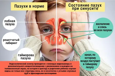 Аденоиды у детей: симптомы, степени гипертрофии и способы удаления,  осложнения после операции