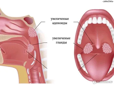 Аденоиды: фото, симптомы, лечение, как удаляют