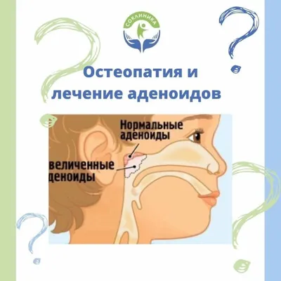 Избавление аденоидов в домашних условиях без врачей и мучений. Моя история  (ID#1546371665), цена: 633 ₴, купить на Prom.ua