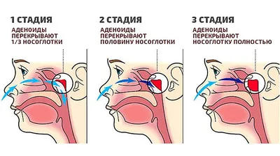 Степени аденоидов