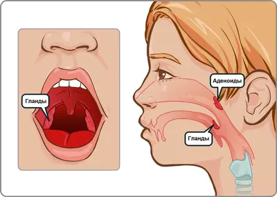 Аденоиды у детей: причины, симптомы и методы лечения | Klinik.by - Клиника  в Уручье