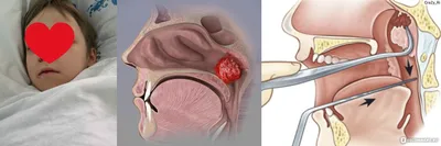 Удаление аденоидов - «МЕГА ОТЗЫВ: Удаление аденоидов под местным наркозом и  Эндоскопическая аденотомия под общим с интервалом в 5 лет. Что выбрать?  Нужно ли удалять аденоиды - наш противоречивый опыт с двумя детьми» | отзывы