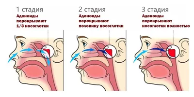 Аденотомия (удаление аденоидов) — Клиника Ланцетъ