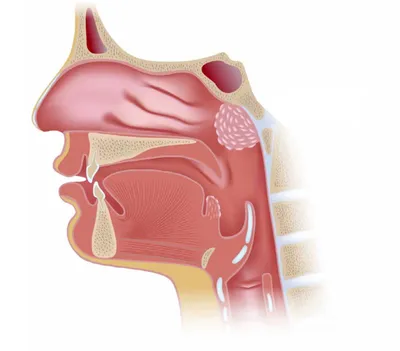 Удаление аденоидов в Москве - аденотомия операция - клиника ЛОР Центр