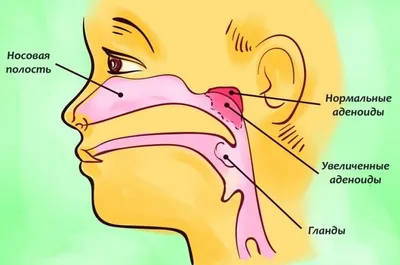 Увеличенные аденоиды в носу у ребенка | Добромед