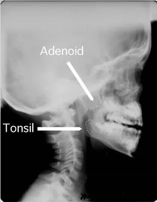 Здравствуйте. Были ли у кого нибудь аденоиды в носу , в возрасте 7 лет ?  Удаляли оперативно ? Что было после ? Не вырастали ли заново ?… | Instagram