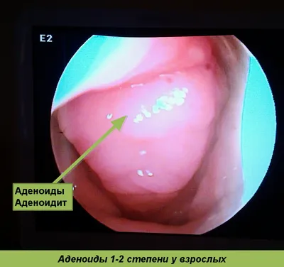 Аденоиды у детей. Чем опасно и как лечится - Лор-нэт