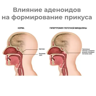 Аденоиды: удалять нельзя лечить! Где поставить запятую? | ЛОР КЛИНИКА  ЗАЙЦЕВА | Дзен