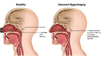 Аденоиды в носу фото