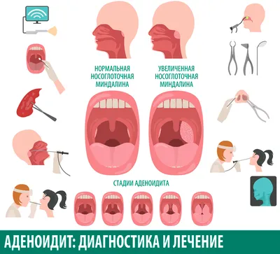 Аденоиды у детей: что такое, диагностика, лечение, симптомы