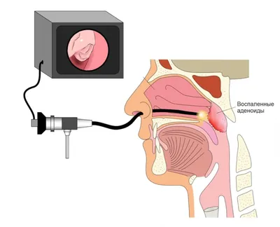 Аденоиды у взрослых и детей: симптомы, степени аденоидной вегетации,  лечение препаратами и удаление | ФОРМА