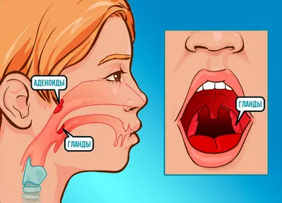 Аденоиды у ребенка | причины, как лечить, последствия | ЛОР Боклин А.К.