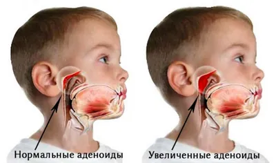 Почему не дышит нос? Аденоиды | Клиника «Александрия» в Нижнем Новгороде