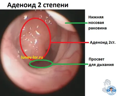 Аденоиды у детей: симтомы, диагностика, лечение | Клиника Эксперт