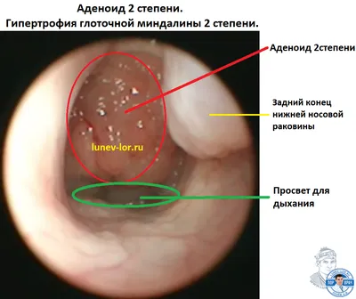 Спрей назальный GlaxoSmithKline Авамис - «Авамис: уменьшаем аденоиды у  ребенка, пытаемся лечить вазомоторный ринит у взрослого. Авамис VS  Назонекс, стоит ли экономить? » | отзывы