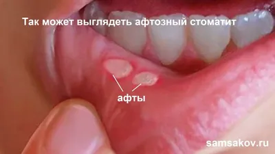 Афтозный стоматит: симптомы, причины и лечение - Альянс бьюти-стоматологов,  Москва