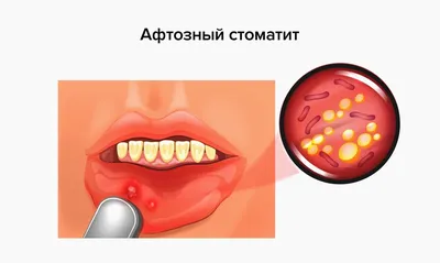 Афтозный стоматит — причины, симптомы, лечение — Startsmile