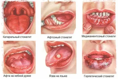 Афтозный стоматит - причины, симптомы, диагностика