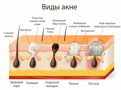 Что такое акне и как его лечить — Семейная консультация