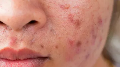 Самые распространенные ошибки в уходе за кожей c акне ZO Skin Health