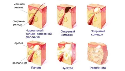 Акне - причины, симптомы, диагностика, лечение и профилактика