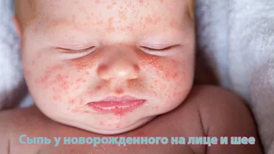 Акне новорожденных! Сыпь у новорожденного ребенка👶\"Гормональное цветение\"  - YouTube