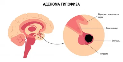 Акромегалия Человеке Тот Здоровый Человек Иллюстрация Показывающая  Увеличение Размера Рук стоковое фото ©katerynakon 664765832