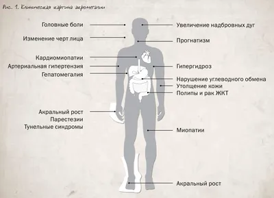 Клинические рекомендации. Акромегалия. Этиопатогенез и клиническая картина.  Часть 1