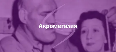 Акромегалия. Определение, эпидемиология, клиника, диагностика и лечение  акромегалии.