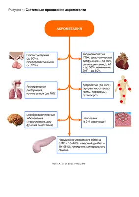 Акромегалия, акромегалия симптомы, болезнь Валуева - 4 сентября 2021 - НГС