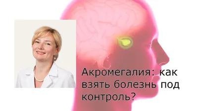 Акромегалия Гигантизм Лицо Симптом Гормон роста, Лицо, угол, лицо, люди png  | Klipartz