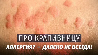 Крапивница у детей. Клинические рекомендации.