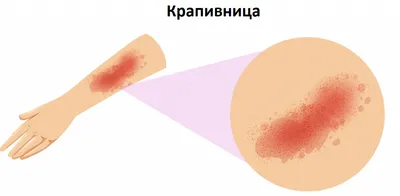 Пигментная крапивница у детей: что это такое, отзыв о лечении